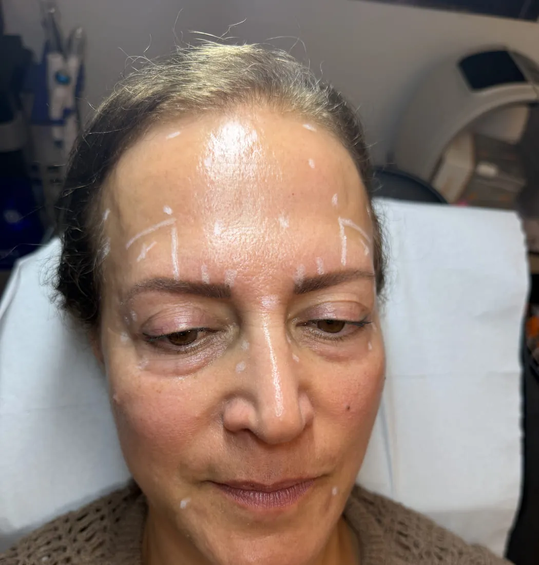 Anti-Wrinkle Treatment at Roniya Aesthetic Clinic
