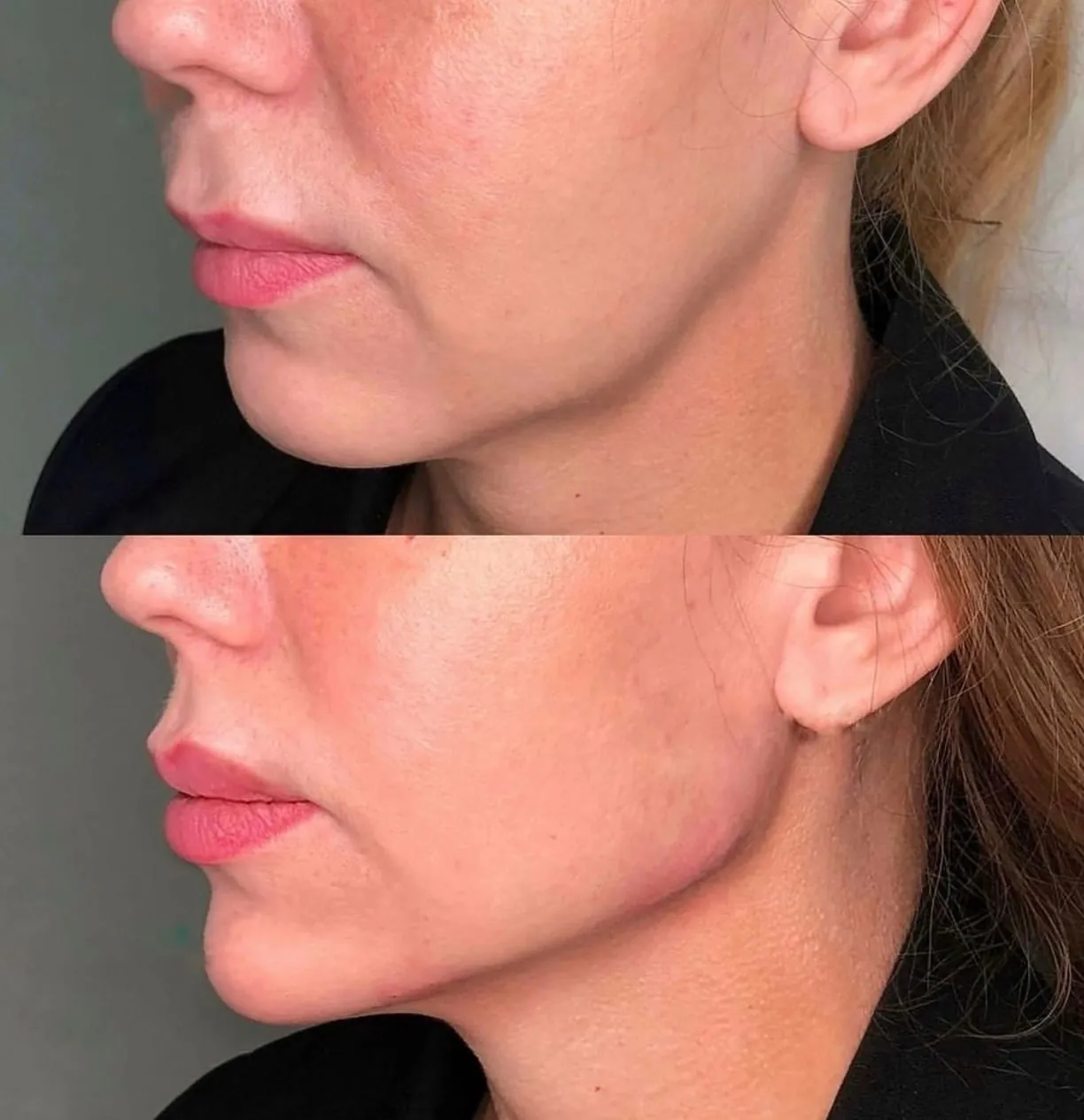Chin Filler at Roniya Aesthetic Clinic
