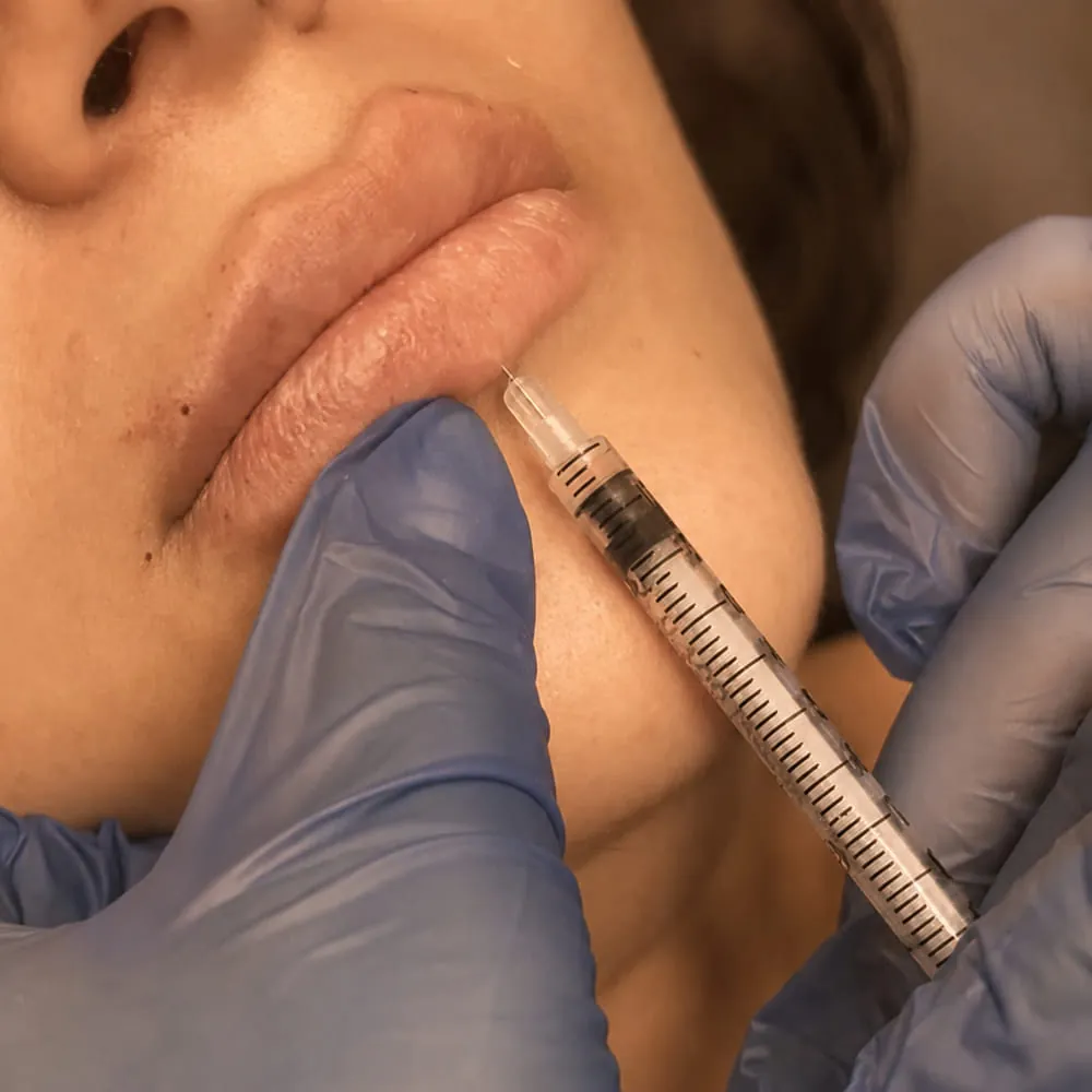 Close-up of a lip filler treatment in progress