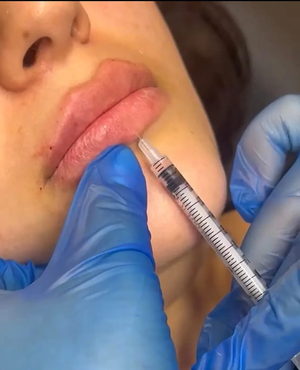 Lip Filler at Roniya Aesthetic Clinic