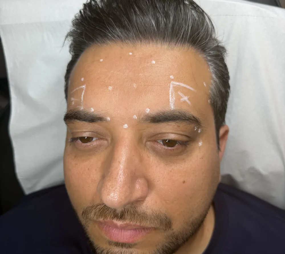 Brow Lift at Roniya Aesthetic Clinic
