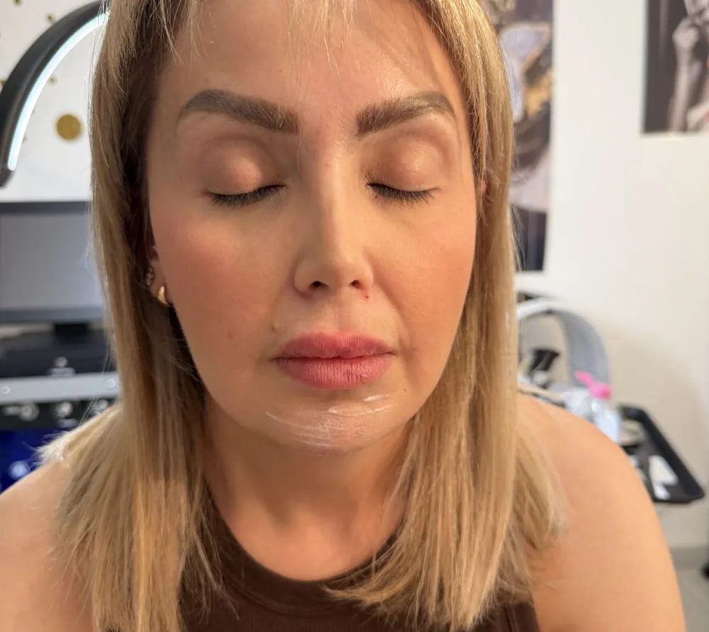 Lip Flip at Roniya Aesthetic Clinic