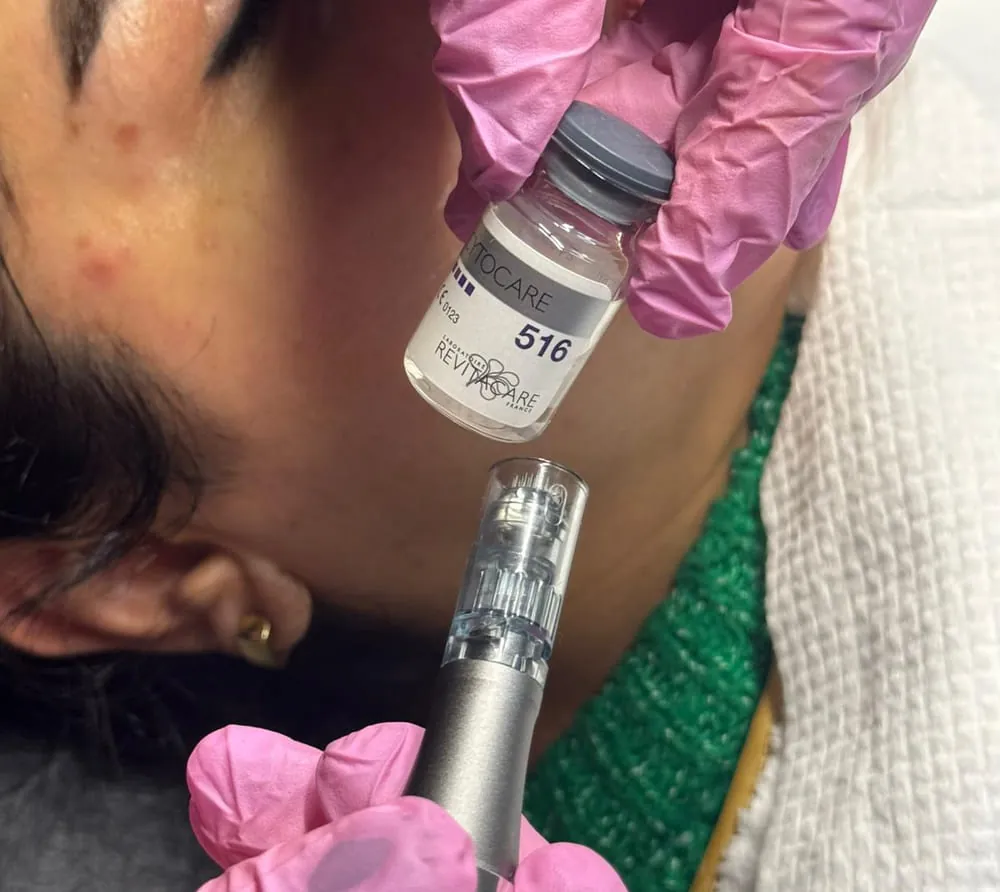 Microneedling at Roniya Aesthetic Clinic