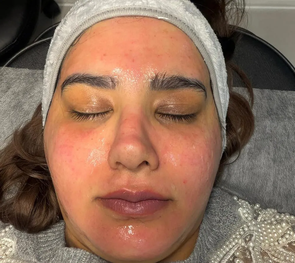 Skin Booster at Roniya Aesthetic Clinic