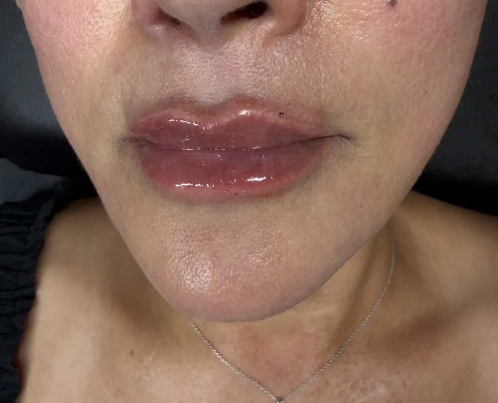 Close-up of a client’s lips after treatment at Roniya Aesthetic Clinic