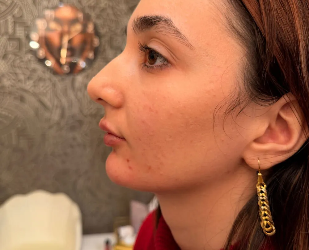 A client in profile at Roniya Aesthetic Clinic