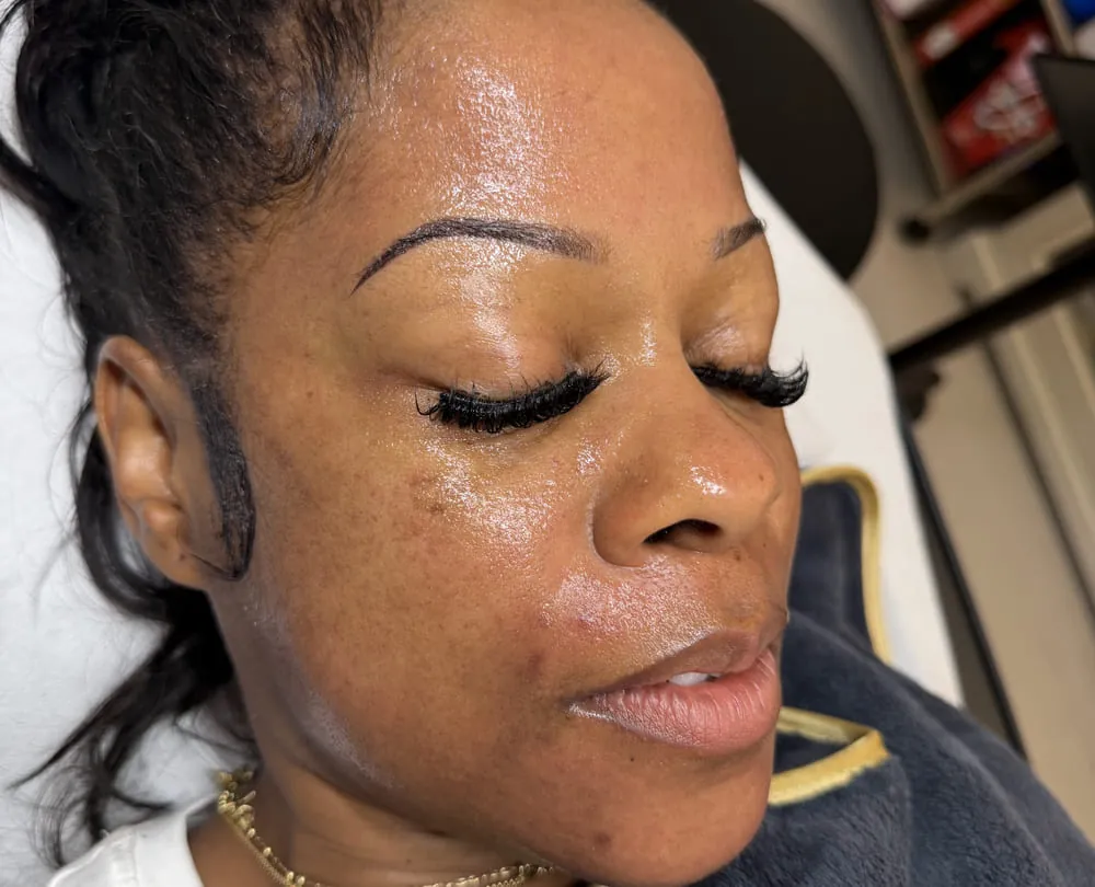 The under eye area of a client at Roniya Aesthetic Clinic