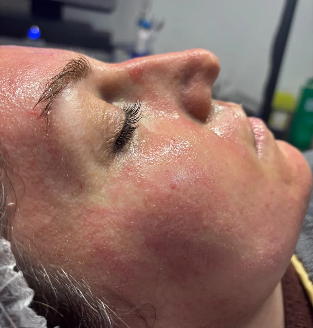 A client immediately after a vampire facial at Roniya Aesthetic Clinic